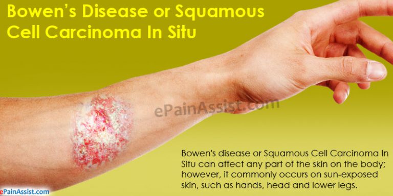 Bowen’s Disease or Squamous Cell Carcinoma In Situ: Causes, Symptoms, Diagnosis, Treatment, Prevention