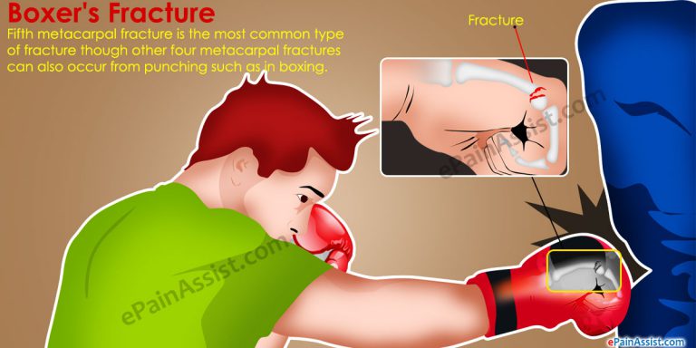 Boxer’s Fracture: Causes, Symptoms, Treatment, Exercises