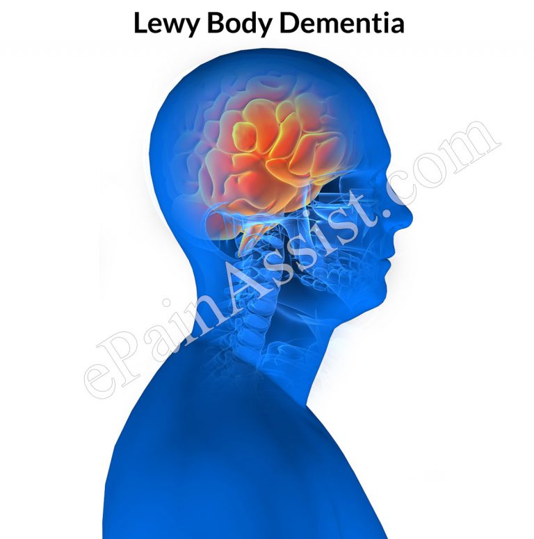 Lewy Body Dementia: Symptoms, Causes, Diagnosis, Treatment- Medication, Therapies