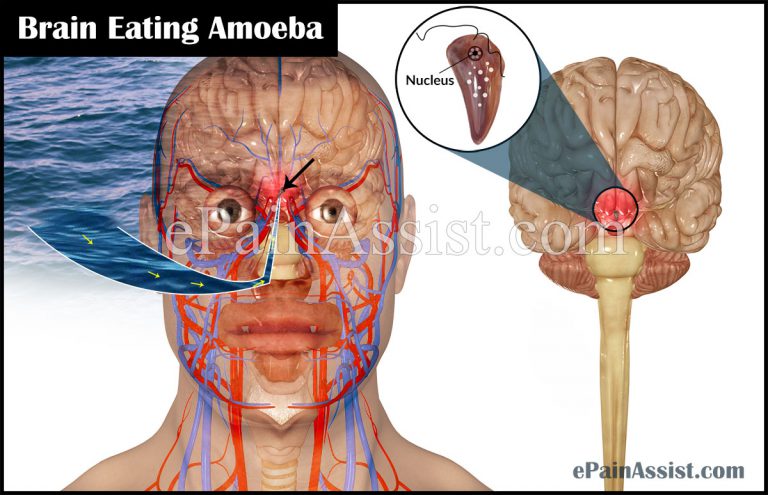 Brain Eating Amoeba or Naegleriasis: Symptoms, Treatment, Prevention