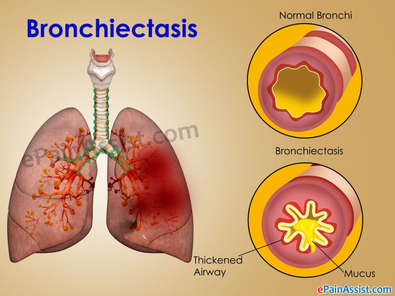 Bronchiectasis: Causes, Symptoms, Diagnosis, Treatment, Prevention