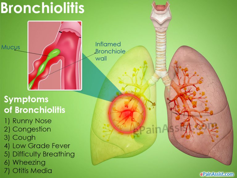 Bronchiolitis: Causes, Who is at Risk, Symptoms, Treatment, Home Remedies, Prevention