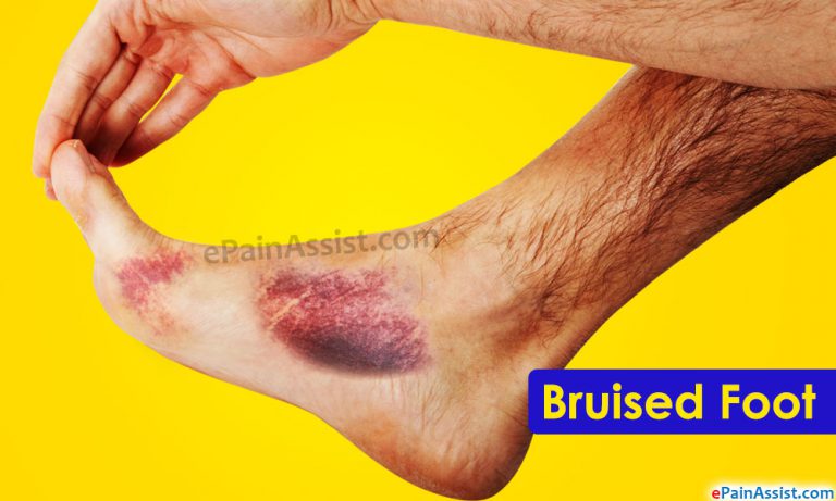 Bruised Foot: Causes, Symptoms, Treatment, Healing Time