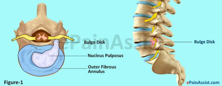 Lumbar Disc Bulge: Causes, Symptoms, Treatment- Manual, Physical, Magnet Therapies