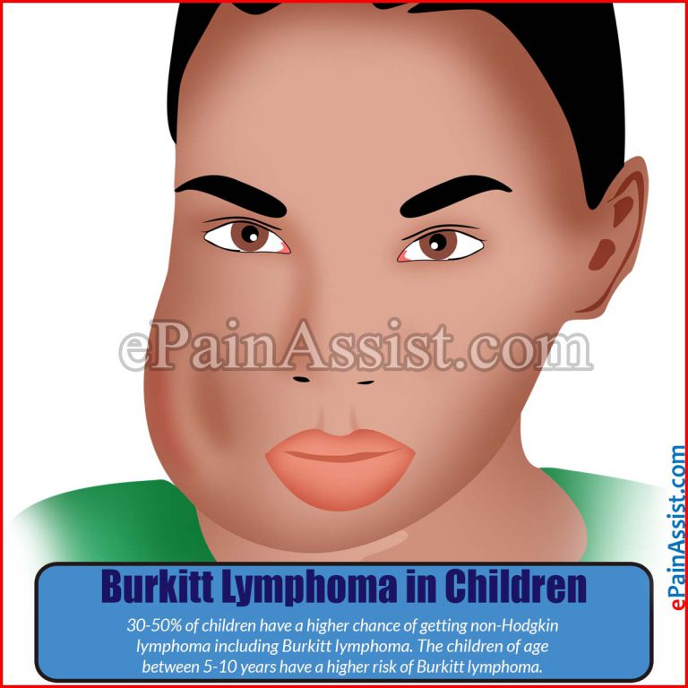 Burkitt Lymphoma: Types, Signs, Symptoms, Stages, Treatment, Survival Rate, Prognosis