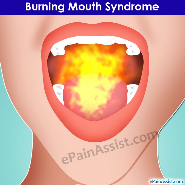 Burning Mouth Syndrome : Causes, Risk Factors, Symptoms, Treatment, Lifestyle Modifications