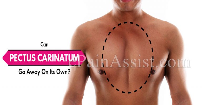 Can Pectus Carinatum Go Away On Its Own & What Are Its Natural Remedies?