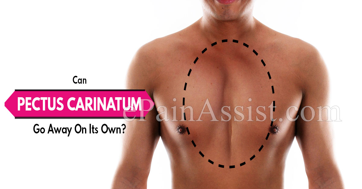 Can Pectus Carinatum Go Away On Its Own?