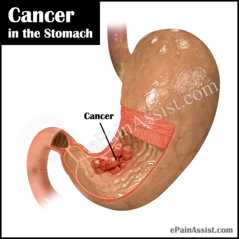 Cancer in the Stomach: Causes, Symptoms, Stages, Treatment, Survival Rate