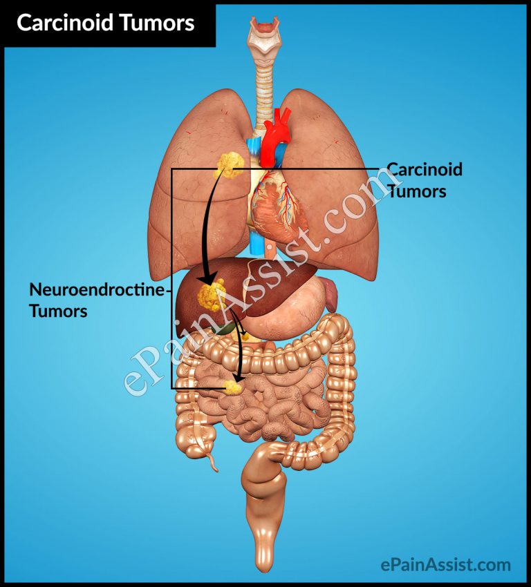Carcinoid Tumors: Causes, Symptoms, Treatment, Surgery, Alternative Treatment, Risk Factors