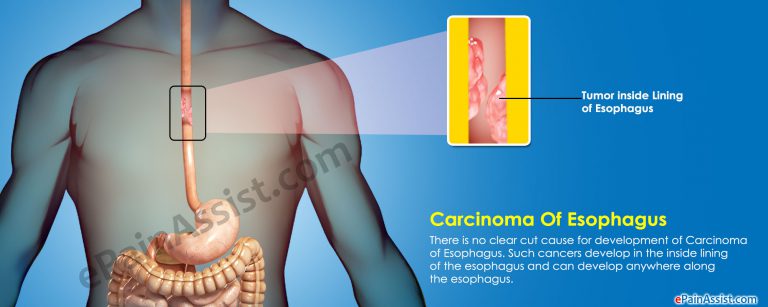 Carcinoma of Esophagus or Esophageal Cancer