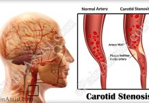 What is Carotid Stenosis or Stenosis of the Carotid Artery & How is it Treated?