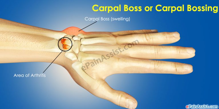 Carpal Boss or Carpal Bossing
