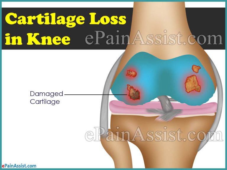 Cartilage Loss in the Knee or No Cartilage in Knee: Causes, Treatment