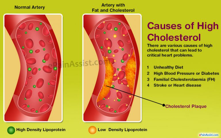 Ways to Reduce LDL Cholesterol and Prevent Its Buildup?