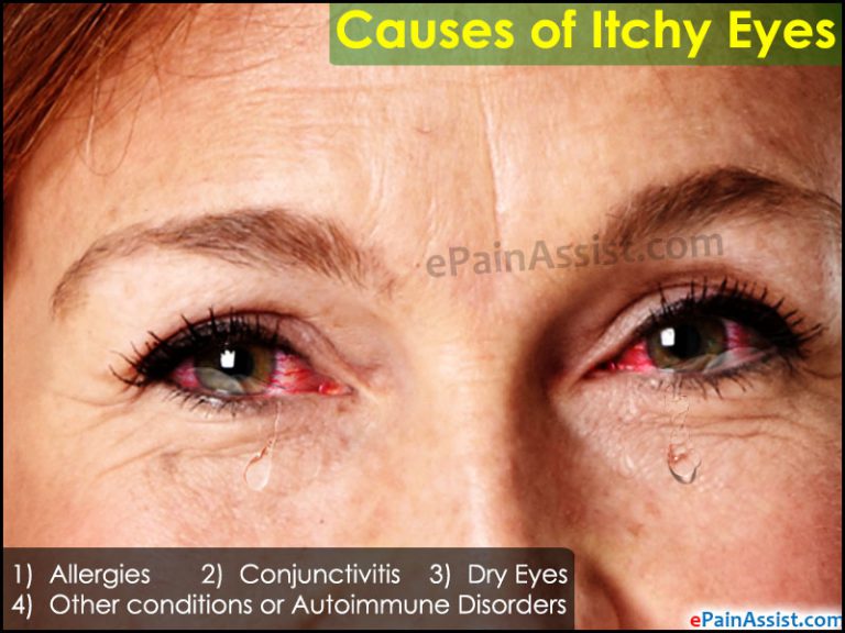 What Causes Eyes To Itch And Home Remedies For Itchy Eyes?