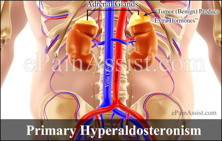 Primary Hyperaldosteronism or Primary Aldosteronism : Causes, Signs, Symptoms, Tests