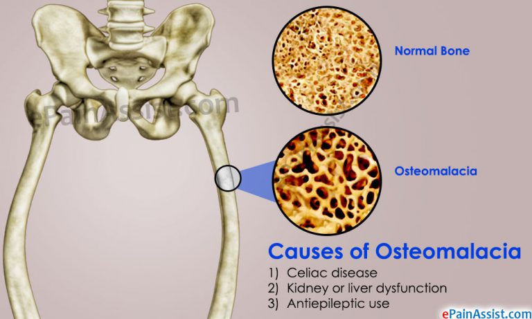 Osteomalacia: Causes, Risk Factors, Symptoms, Diagnosis, Treatment, Prevention