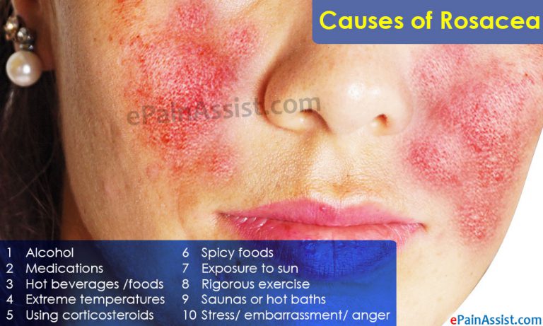 Rosacea: Causes, Risk Factors, Signs, Symptoms, Treatment- Medications, Surgery, Home Remedies