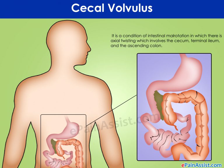 Cecal Volvulus: Treatment, Diet, Causes, Symptoms, Diagnosis