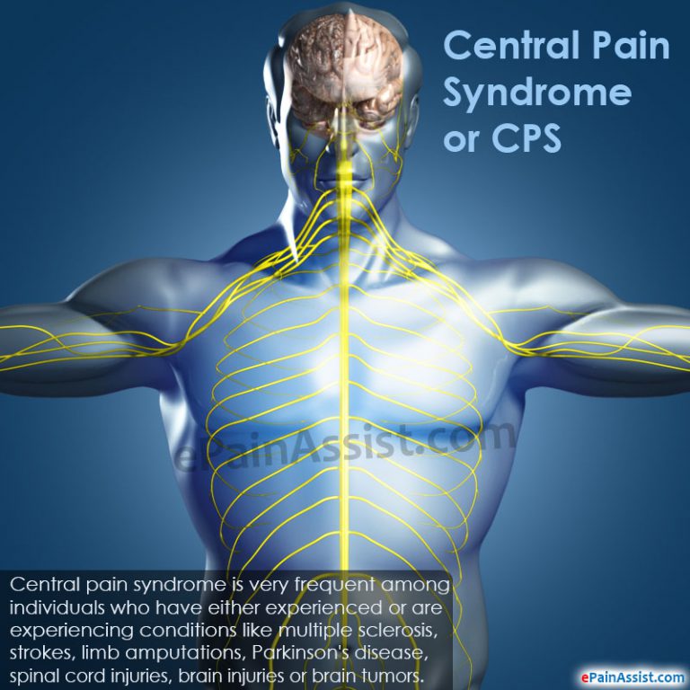 Central Pain Syndrome or CPS: Epidemiology, Causes, Symptoms, Treatment, Diagnosis