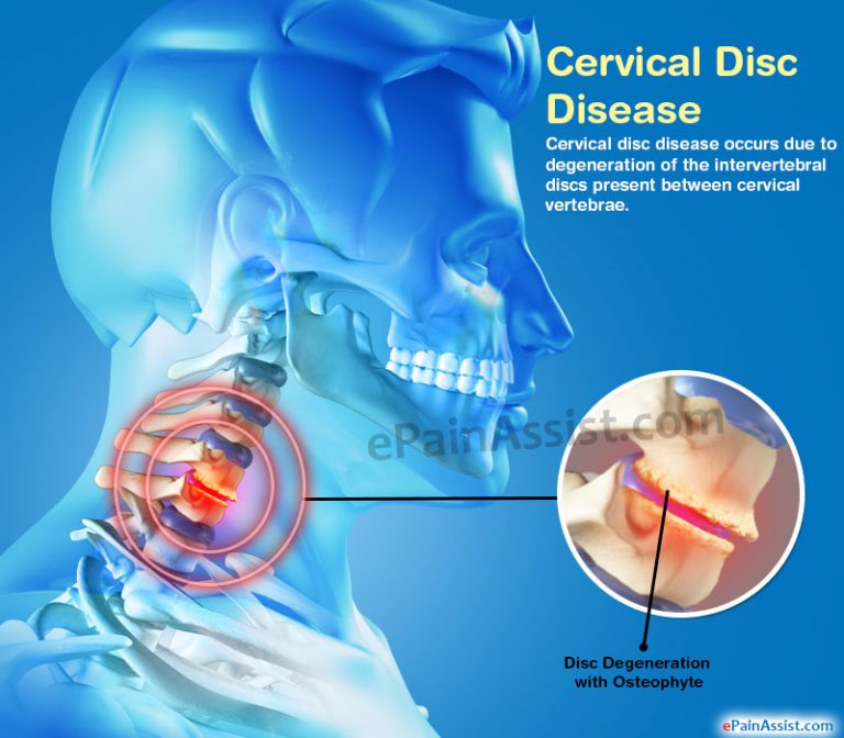 Cervical Disc Disease: Symptoms, Treatment, Lifestyle Management