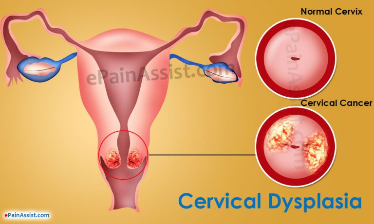 Cervical Dysplasia: Stages, Causes, Symptoms, Pregnancy, Treatment, Prognosis, Prevention