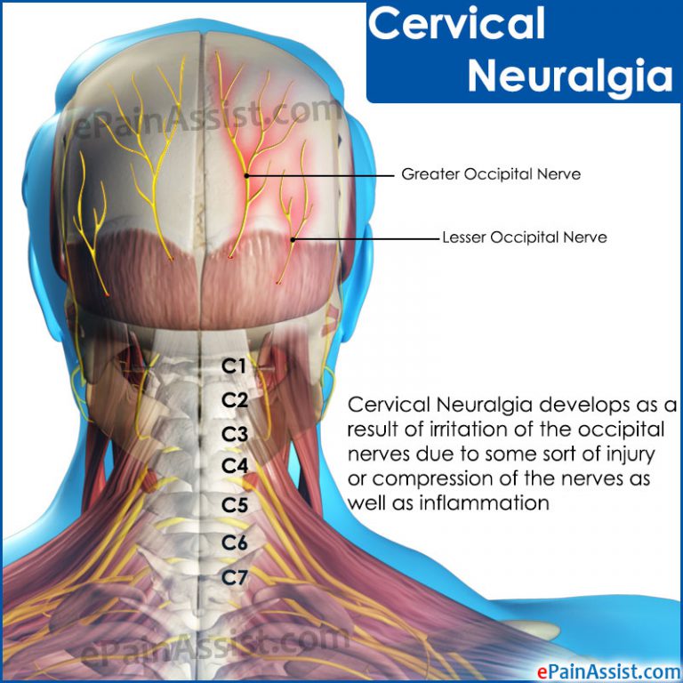 Cervical Neuralgia: Causes, Symptoms, Treatment, Diagnosis