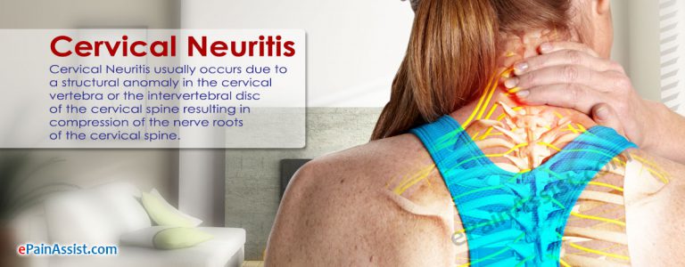 What Is Cervical Neuritis?