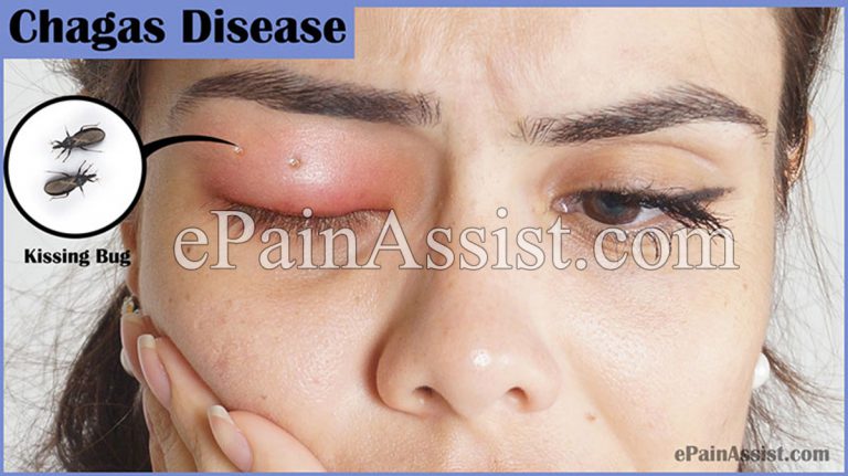 Chagas Disease or Kissing Bug Disease: Causes, Symptoms, Treatment, Prognosis