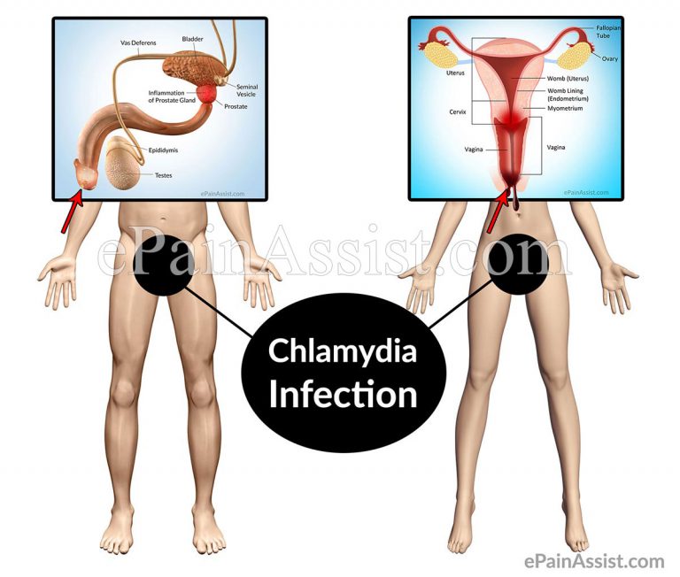 Chlamydia Infection: Causes, Symptoms, Treatment, Prevention