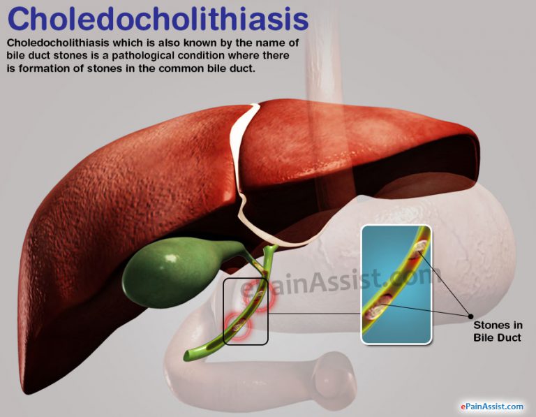 Choledocholithiasis: Causes, Symptoms, Treatment