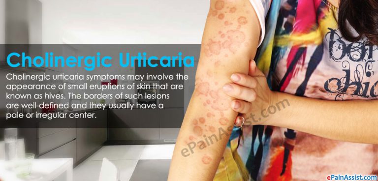 What Is Cholinergic Urticaria?