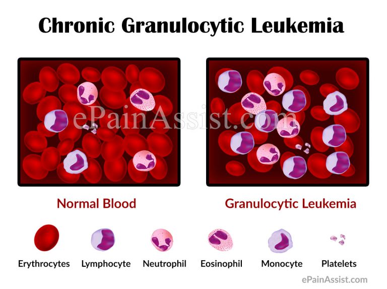 Chronic Granulocytic Leukemia: Causes, Signs and Symptoms, Treatment