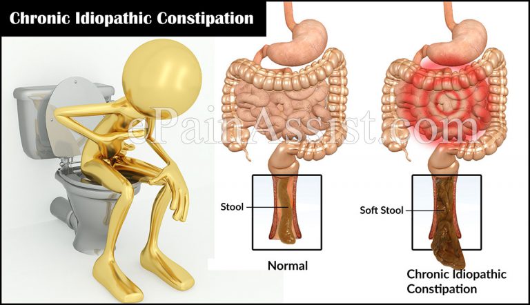 What is Chronic Idiopathic Constipation and How is it Treated?