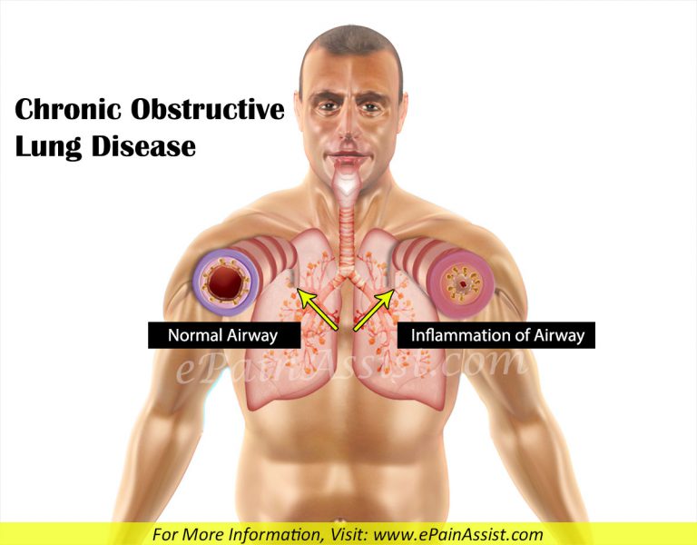 Chronic Obstructive Lung Disease or Chronic Obstructive Airway Disease