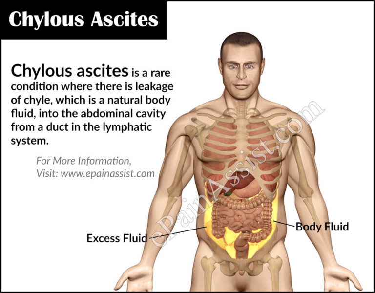 What is Chylous Ascites and How is it Treated?