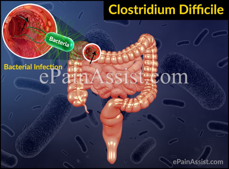 Clostridium Difficile or C. Difficile Infection: Causes, Symptoms, Treatment