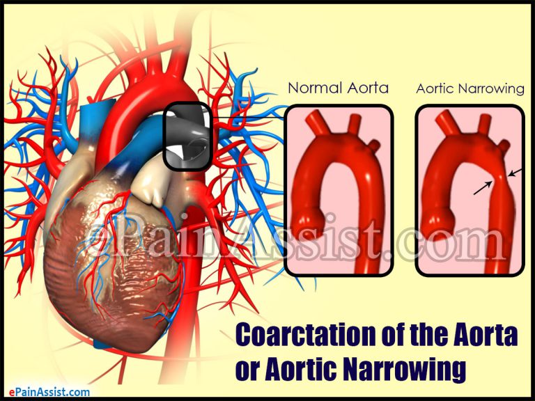 Coarctation of the Aorta or Aortic Narrowing: Risk Factors,Complications, Diagnosis