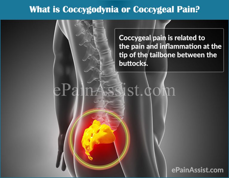 Coccygodynia or Coccygeal Pain: Causes, Pathophysiology, Symptoms, Risk Factors