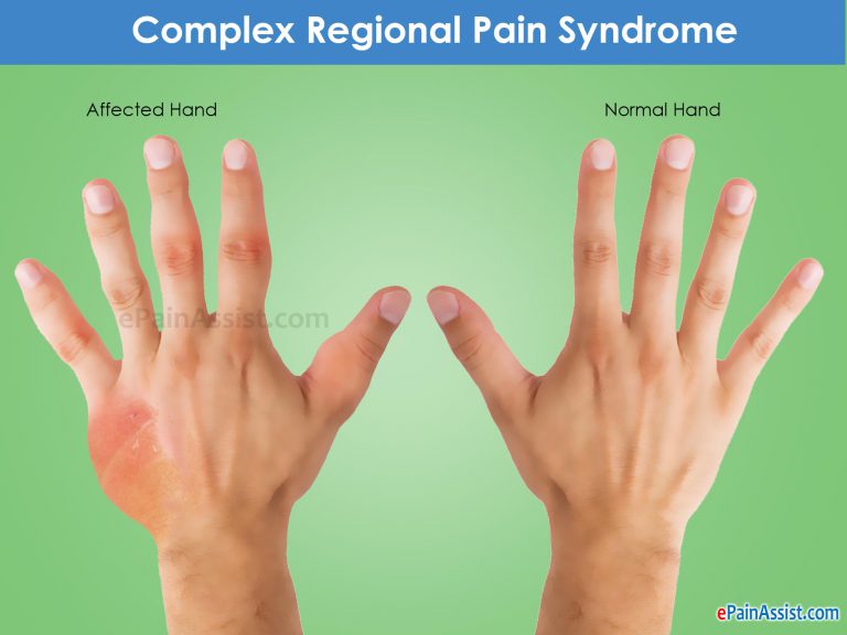 Residual CRPS After Auto Accident