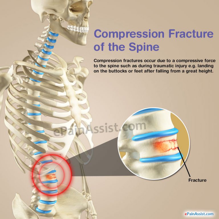 Compression Fracture of the Spine: Understand the Causes, Symptoms, Different Treatment Options