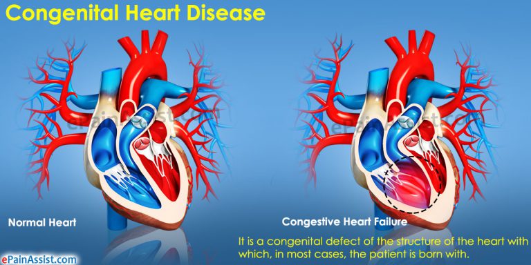 Congenital Heart Disease: Causes, Symptoms, Treatment