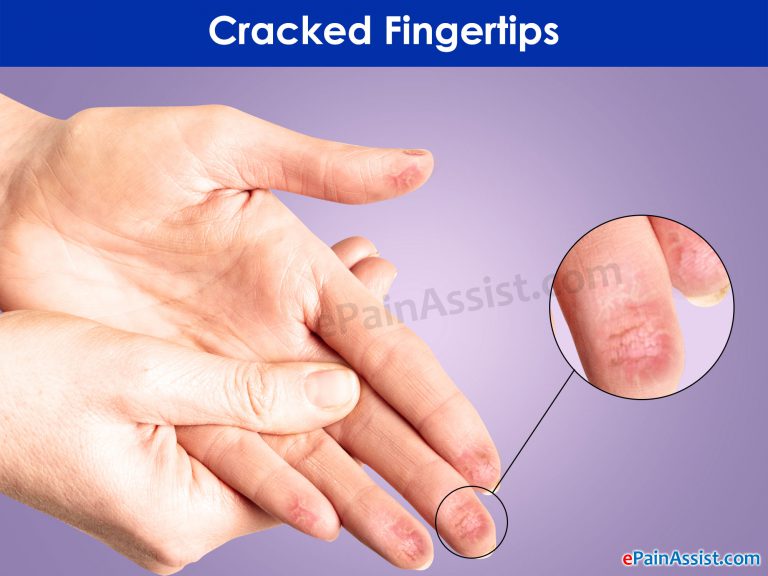 Cracked Fingertips: Causes, Treatment, Prevention