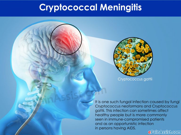 Cryptococcal Meningitis