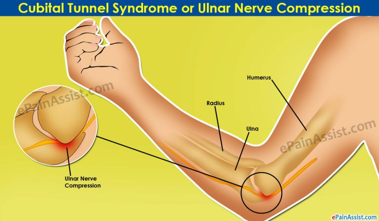 Cubital Tunnel Syndrome or Ulnar Nerve Compression: Symptoms, Causes, Treatment