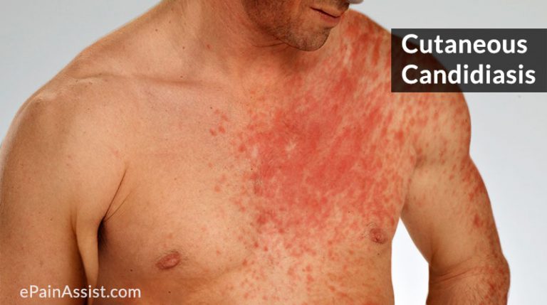 Cutaneous Candidiasis or Skin Candidiasis: Causes, Signs, Symptoms, Investigations, Treatment