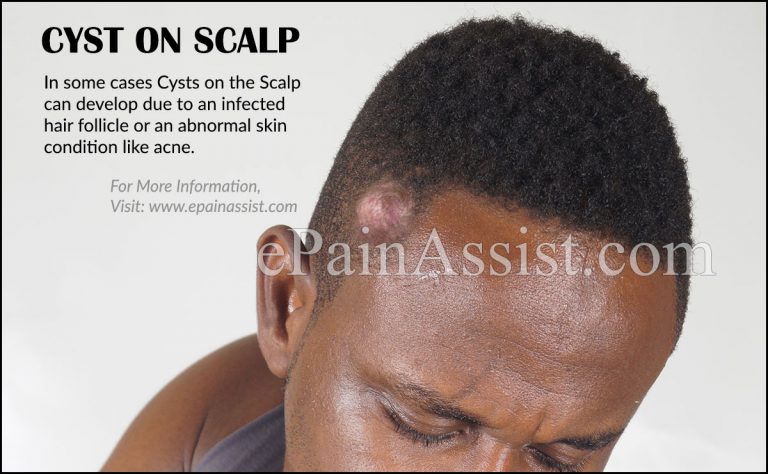 Cyst on Scalp: Causes, Symptoms, Treatment