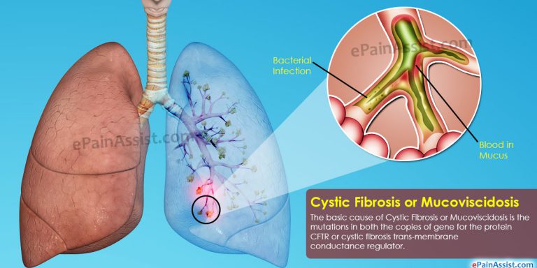 Cystic Fibrosis or Mucoviscidosis: Life Expectancy, Self Care, Diet, Exercise