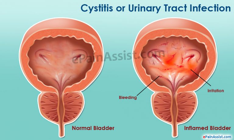 Cystitis or Urinary Tract Infection (UTI): Symptoms, Treatment, Home Remedies